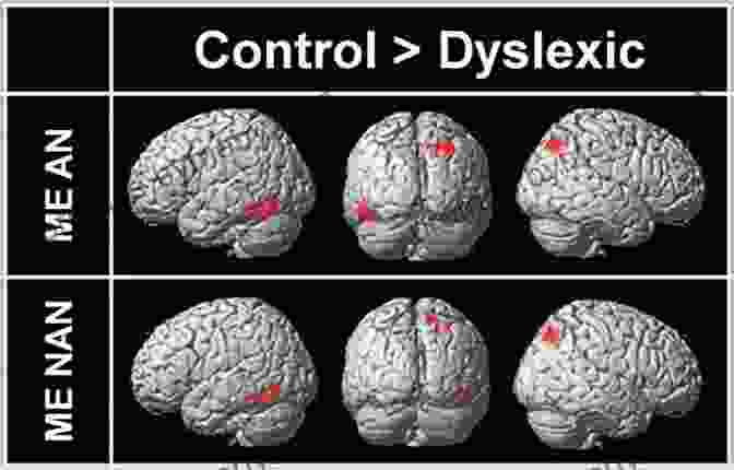 A Brain Scan Showing Dyslexia The Gift Of Dyslexia Revised And Expanded: Why Some Of The Smartest People Can T Read And How They Can Learn